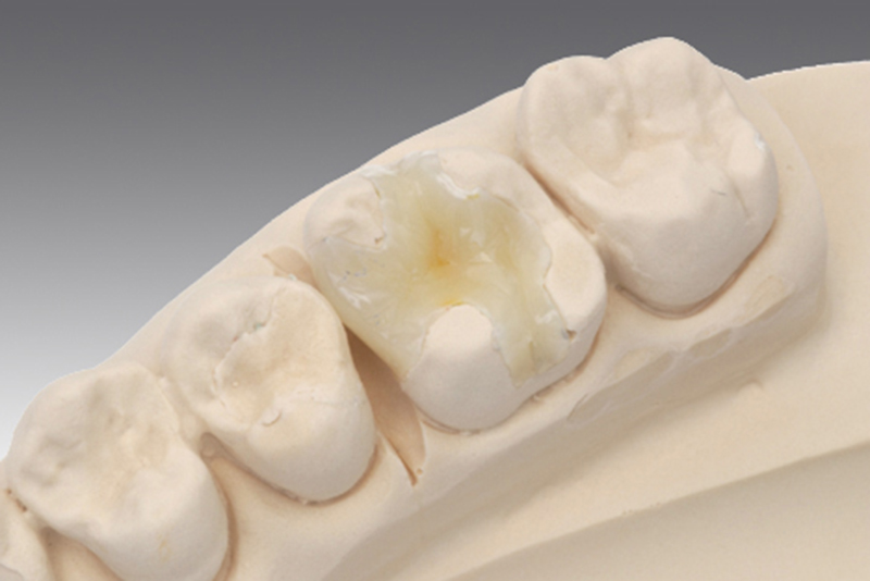 セラミックインレー