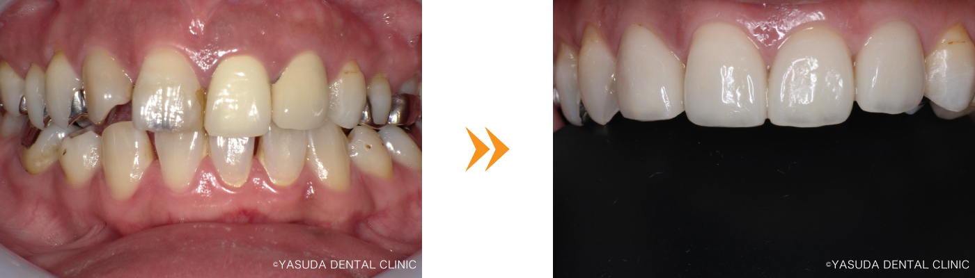 オールセラミッククラウンの症例
