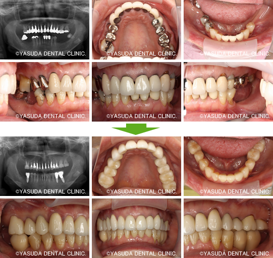 オールセラミッククラウンとインプラント