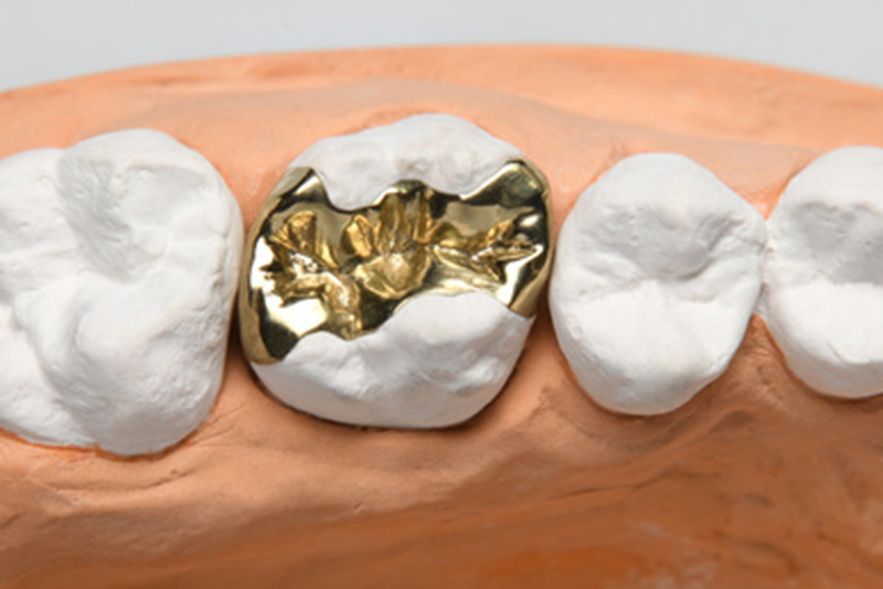 ゴールドインレー