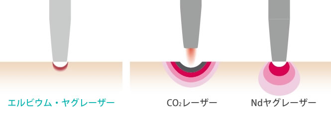 エルビウム・ヤグレーザー