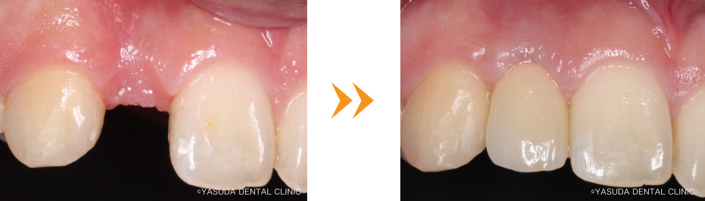 インプラント症例
