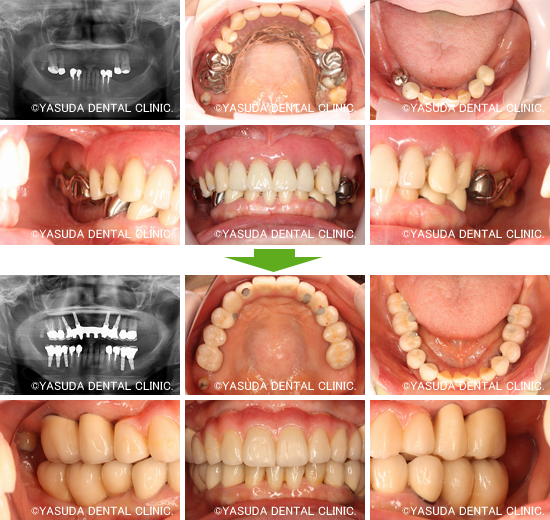インプラントブリッジの症例