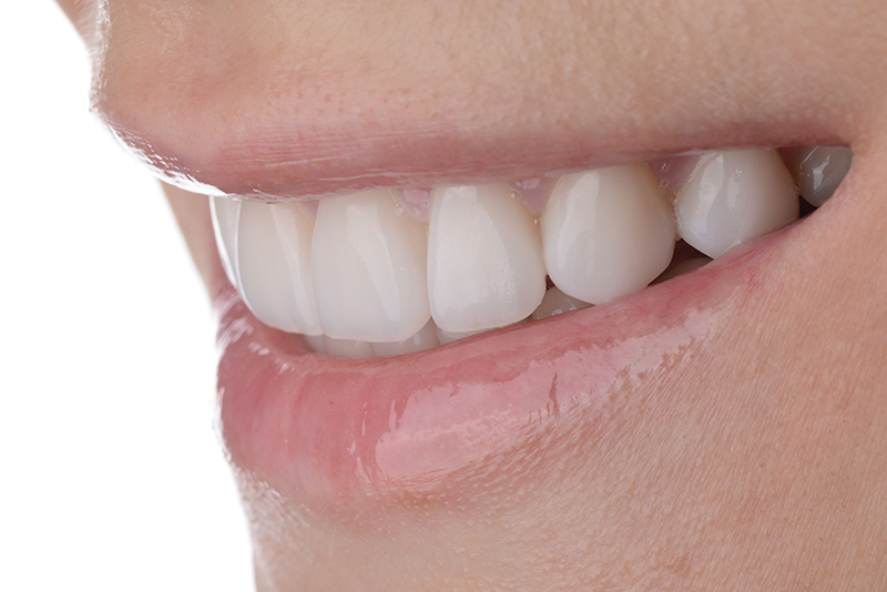 インプラントのメリット