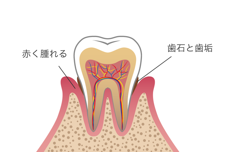 歯周病の進行
