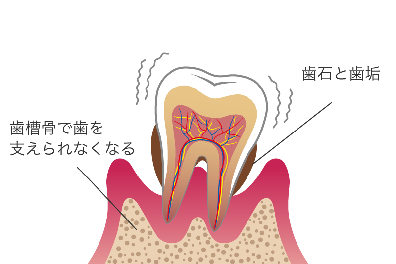 歯周病の進行