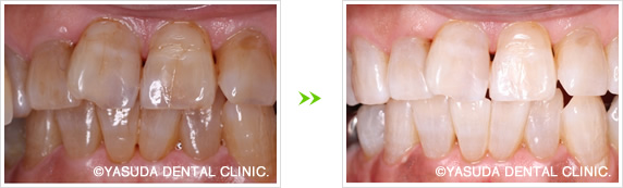 ポリリン酸ホワイトニング症例1
