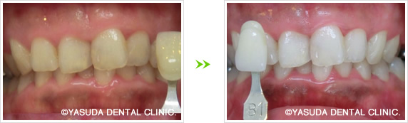 ポリリン酸ホワイトニング症例2